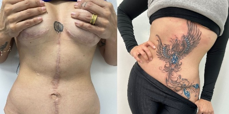Tatuagens ressignificam cicatrizes de vítimas de violência doméstica e de cirurgias mal feitas
