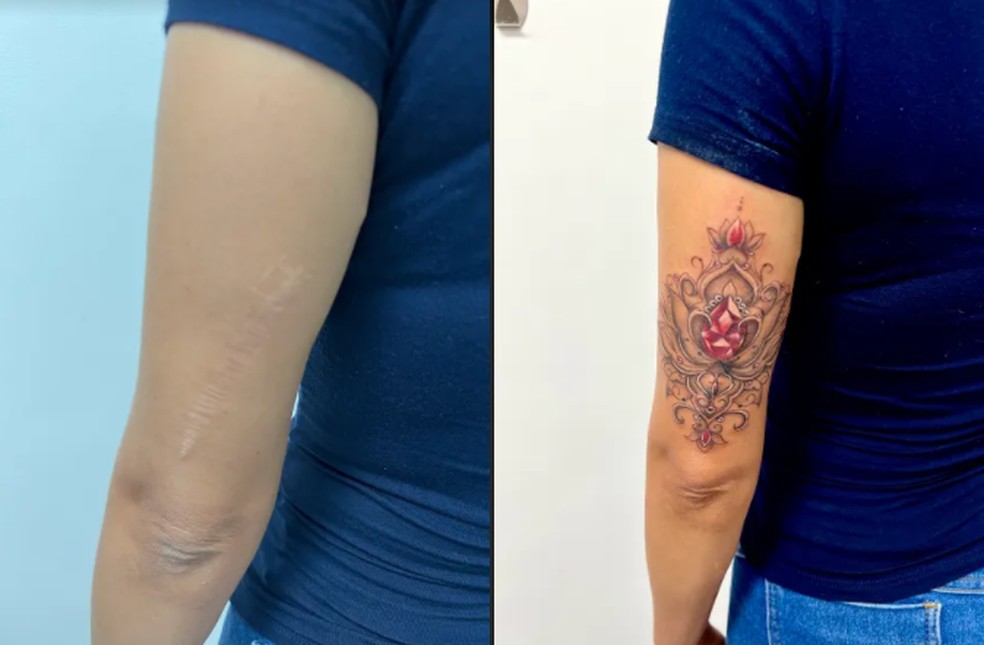 Tatuagens ressignificam cicatrizes de vítimas de violência doméstica e de cirurgias mal feitas