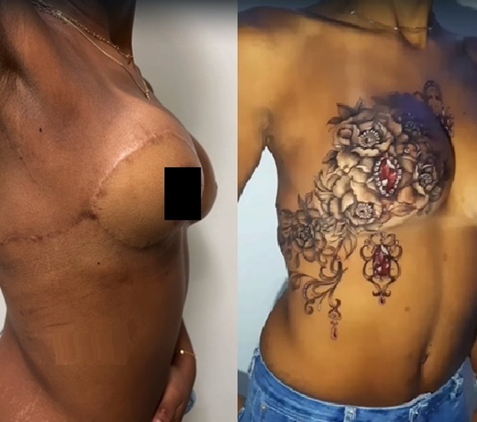 Tatuagens ressignificam cicatrizes de vítimas de violência doméstica e de cirurgias mal feitas