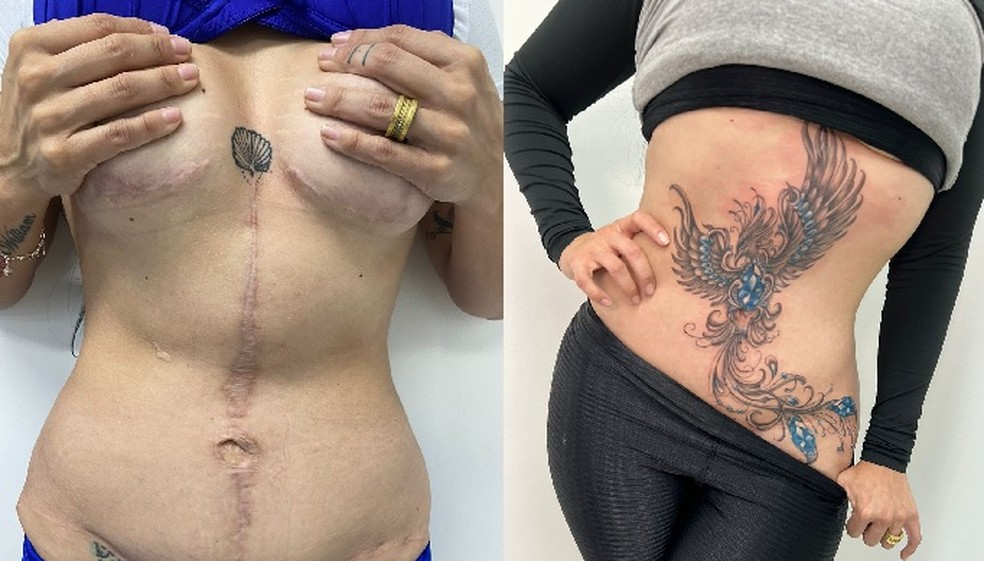 Tatuagens ressignificam cicatrizes de vítimas de violência doméstica e de cirurgias mal feitas