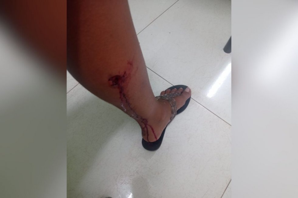 IVINHEMA: Jovem é mordida por cachorro no Bairro Vitória e caso acende alerta sobre animais soltos