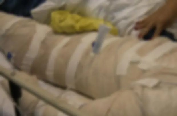 Menino de 11 anos fica em estado grave depois ter corpo queimado em brincadeira com álcool